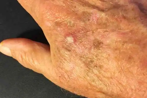 Cryopen For Actinic Keratoses 1 Image of Actinic keratoses York on a person hand