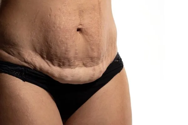 The Science of Skin Tightening 1 The science behind skin tightening York picture of a woman's sagging skin on the stomach